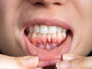 Ejemplo de enfermedad periodontal