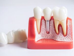 Ilustración de un implante dental