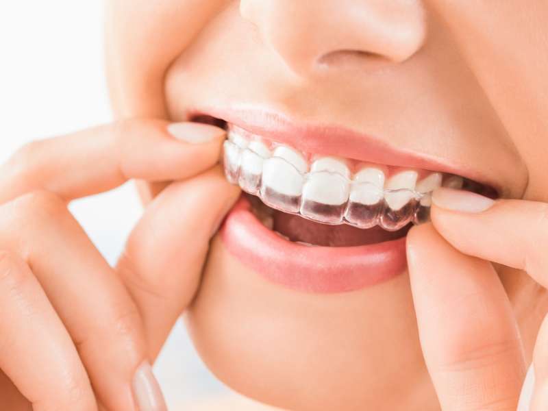 tratamientos dentales en Terrassa