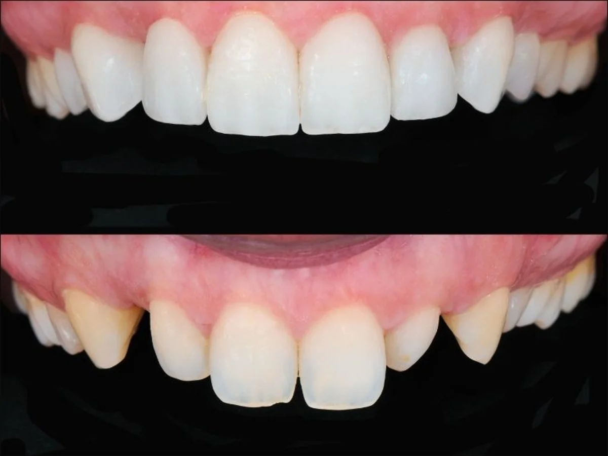 Diseño de antes y después de carillas dentales en Terrassa