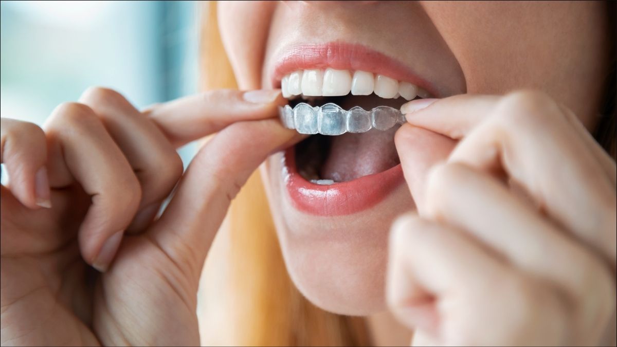 Mujer joven sonriendo con ortodoncia invisible en Terrassa