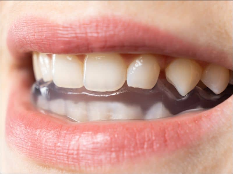 Férula de descarga para tratar el bruxismo