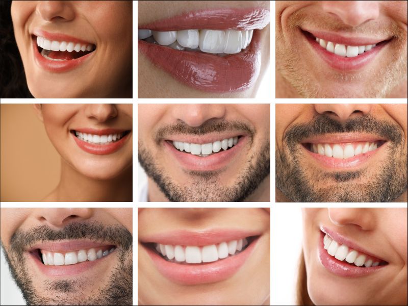 Tendencias en carillas dentales 2025 en redes sociales