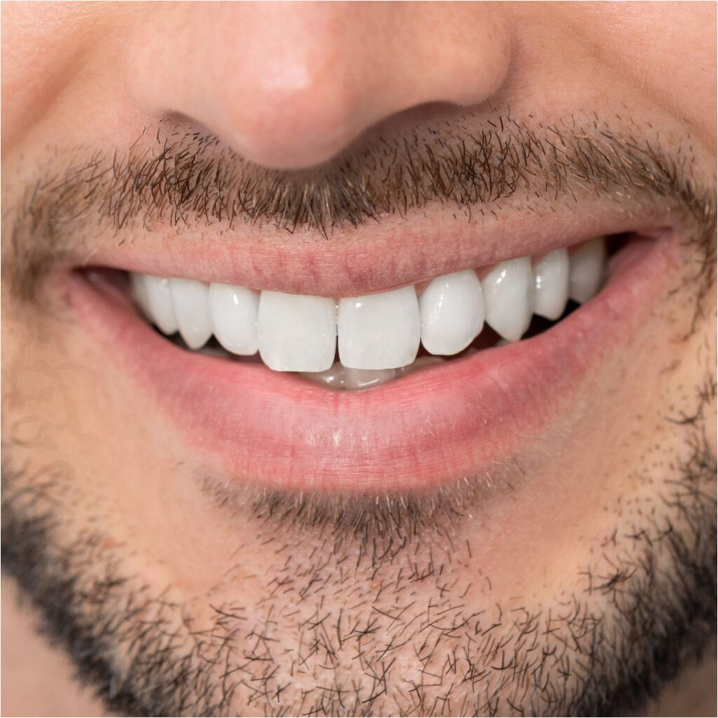 Tendencias en carillas dentales en hombres