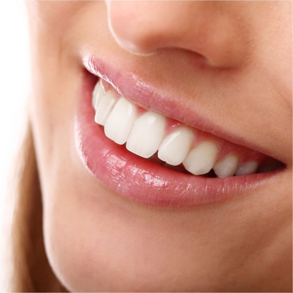 Tendencias en carillas dentales en mujeres
