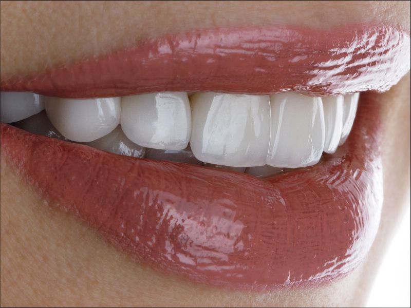 Ejemplo de tendencias en carillas dentales