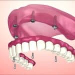 Imagen de prótesis sobre implantes