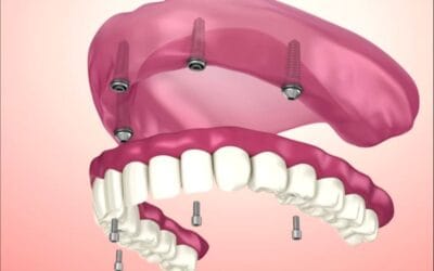 Imagen de prótesis sobre implantes