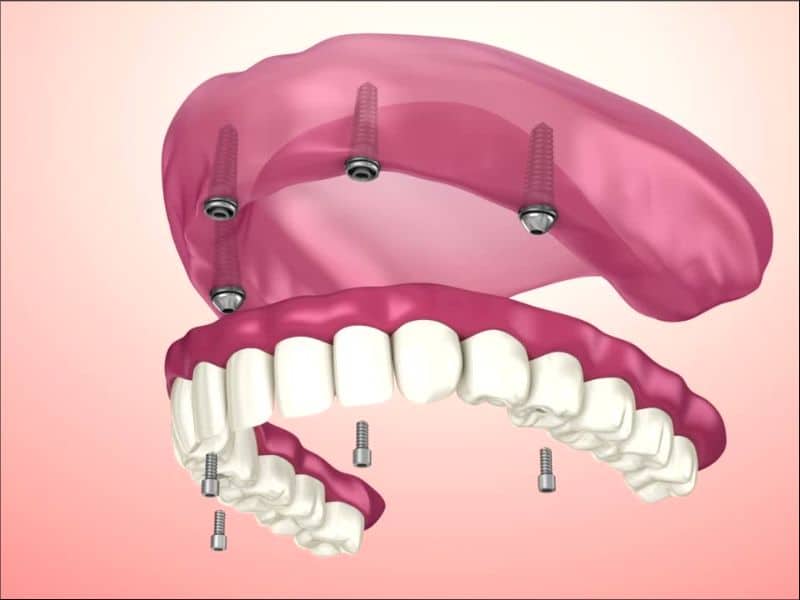 Imagen de prótesis sobre implantes
