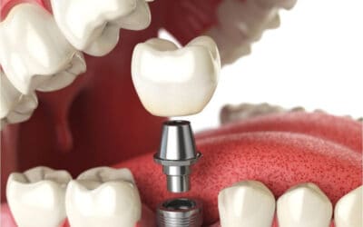 implantes-dentales-carga-inmediata
