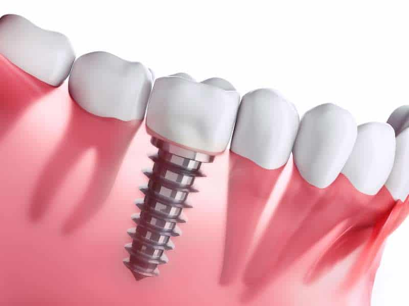 implantes-dentales-terrassa