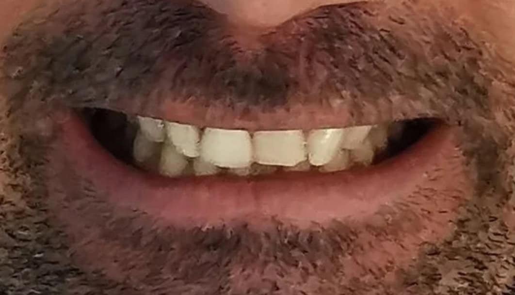 ortodoncia-invisible-01-A