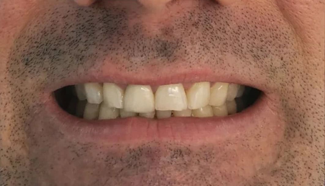 ortodoncia-invisible-01-B