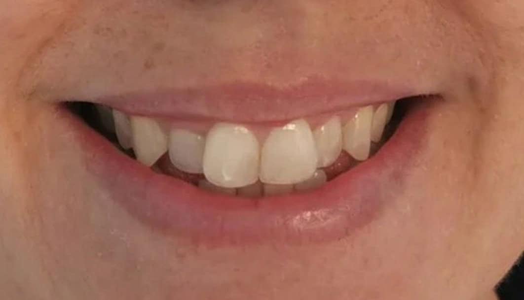 ortodoncia-invisible-02-A