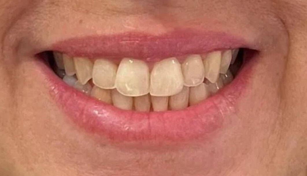 ortodoncia-invisible-02-B