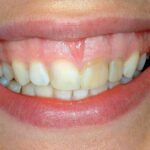 Sonrisa gingival al sonreír