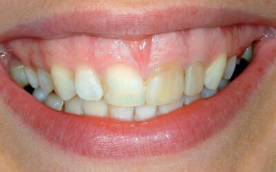 sonrisa con encías visibles al reír Sonrisa gingival al sonreír