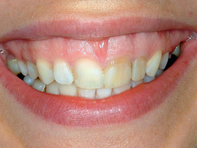 Sonrisa gingival al sonreír