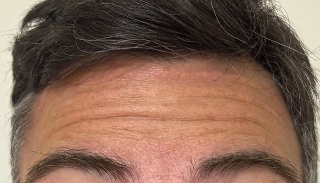 tratamiento-estico-02-A