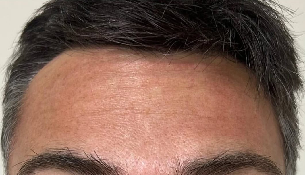 tratamiento-estico-02-B