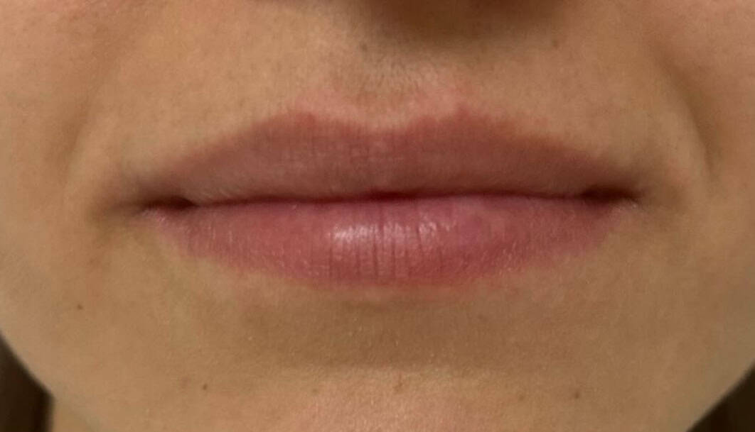 tratamiento-estico-labios-01-A