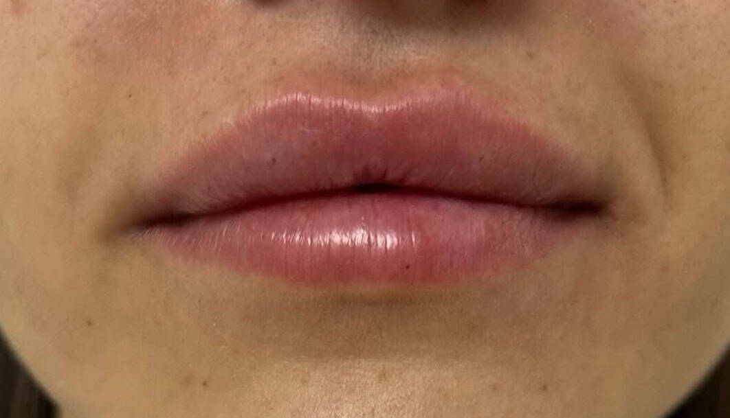 tratamiento-estico-labios-01-B