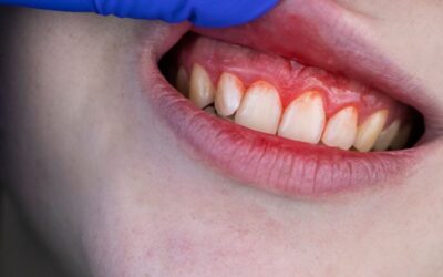 Síntomas de gingivitis y periodontitis