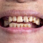 Dentadura con errores que envejecen tu sonrisa