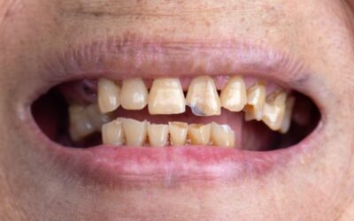 Dentadura con errores que envejecen tu sonrisa