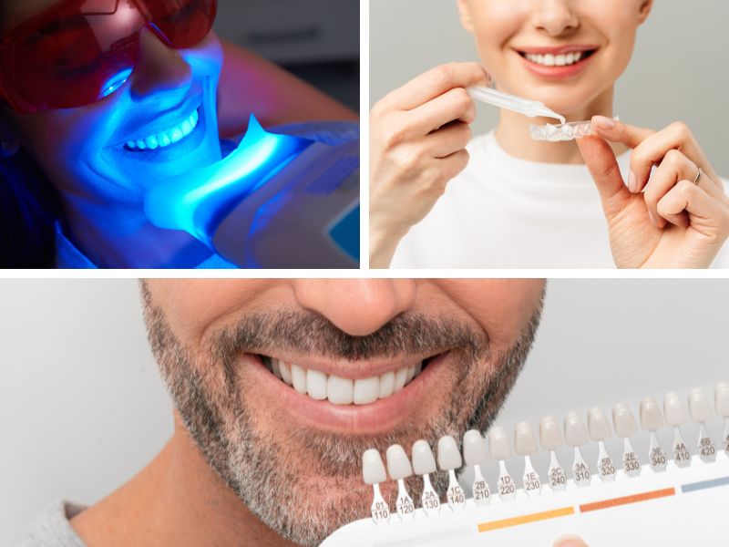 Tipos de blanqueamiento dental