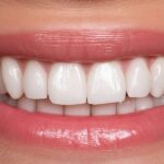 Cuánto duran las carillas dentales y resultado natural