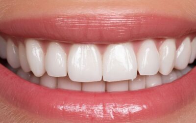 Cuánto duran las carillas dentales y resultado natural