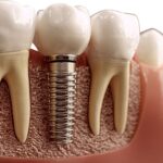 Cuánto cuesta un implante dental en Terrassa y resultado natural