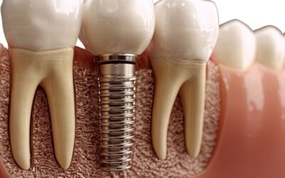 Cuánto cuesta un implante dental en Terrassa y resultado natural