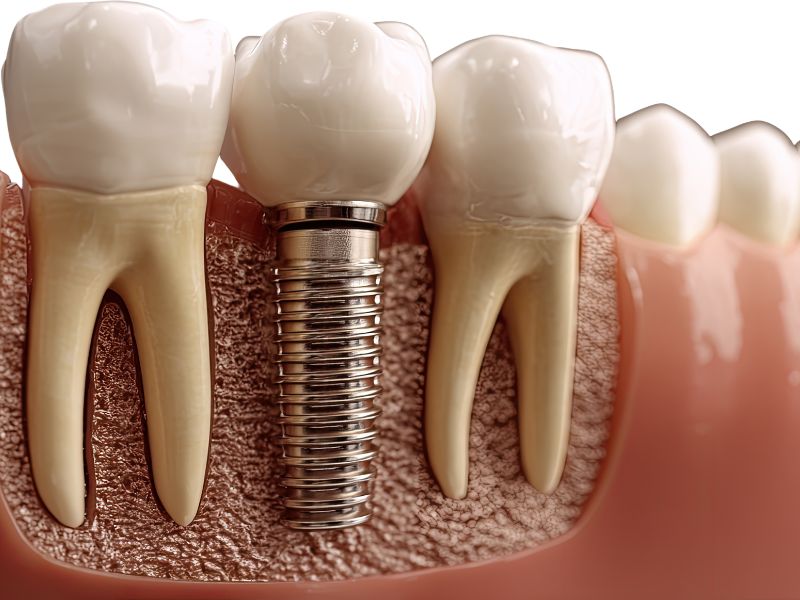 Cuánto cuesta un implante dental en Terrassa y resultado natural