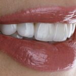 Diferencias entre carillas dentales naturales y artificiales