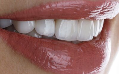 Diferencias entre carillas dentales naturales y artificiales