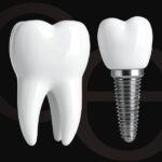 Todo lo que debes saber sobre los implantes dentales y resultado natural
