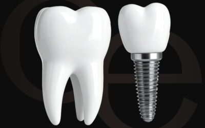 Todo lo que debes saber sobre los implantes dentales y resultado natural