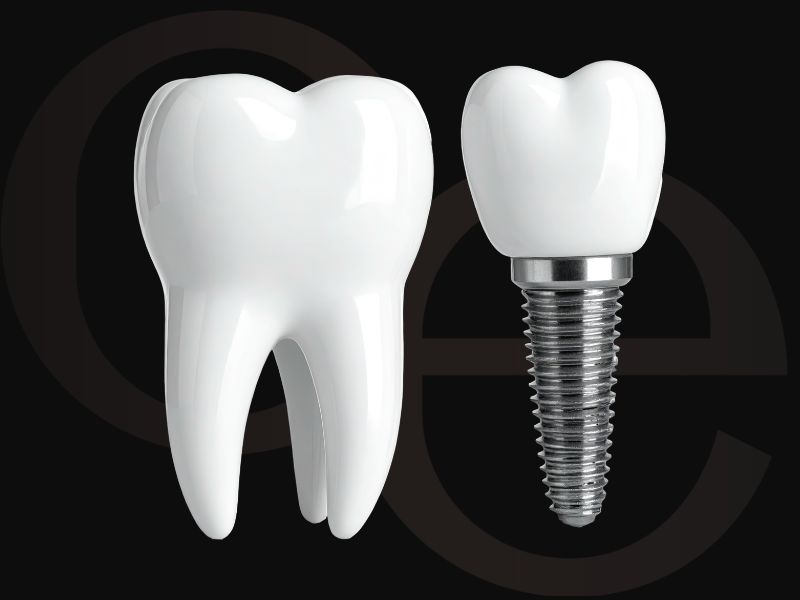 Todo lo que debes saber sobre los implantes dentales y resultado natural