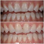 Manchas blancas en los dientes y tratamiento estético dental
