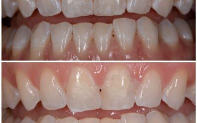 Manchas blancas en los dientes y tratamiento estético dental