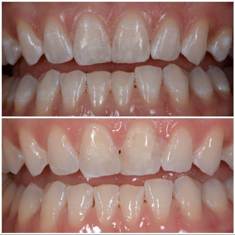 Manchas blancas en los dientes y tratamiento estético dental