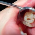Detección de caries dental en visita