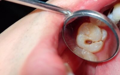 Detección de caries dental en visita