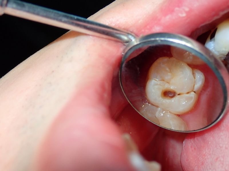 Detección de caries dental en visita