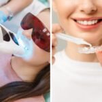 Blanqueamiento dental clínico o domiciliario profesional.
