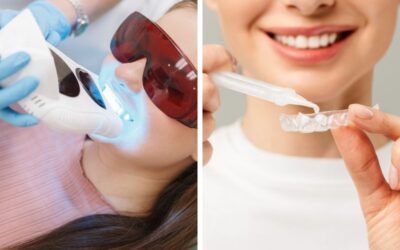 Blanqueamiento dental clínico o domiciliario. Blanqueamiento dental clínico o domiciliario profesional.
