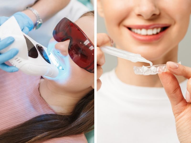 Blanqueamiento dental clínico o domiciliario profesional.